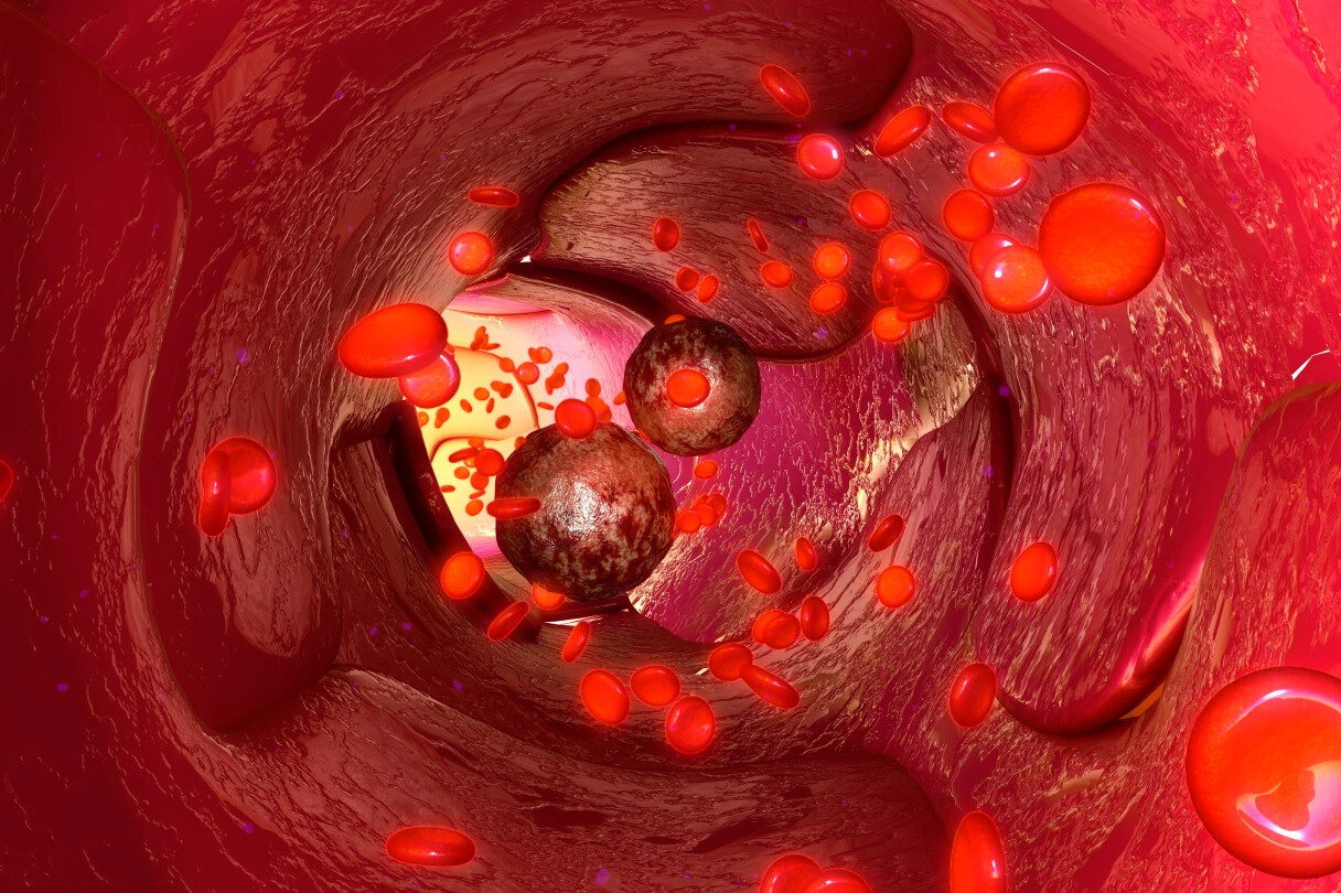 Высокий холестерин может увеличить шанс того, что у больных раком появятся метастазы
