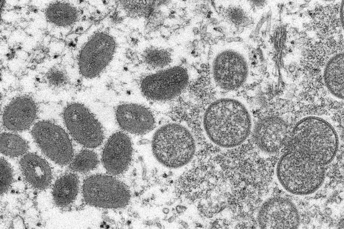 Существует ли вакцина от оспы обезьян и что с ней не так