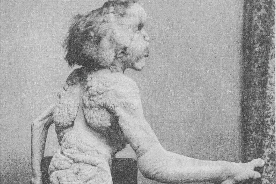 Романтичная натура, фрик-шоу и смерть в 27: интересные факты о реальном Человеке-слоне