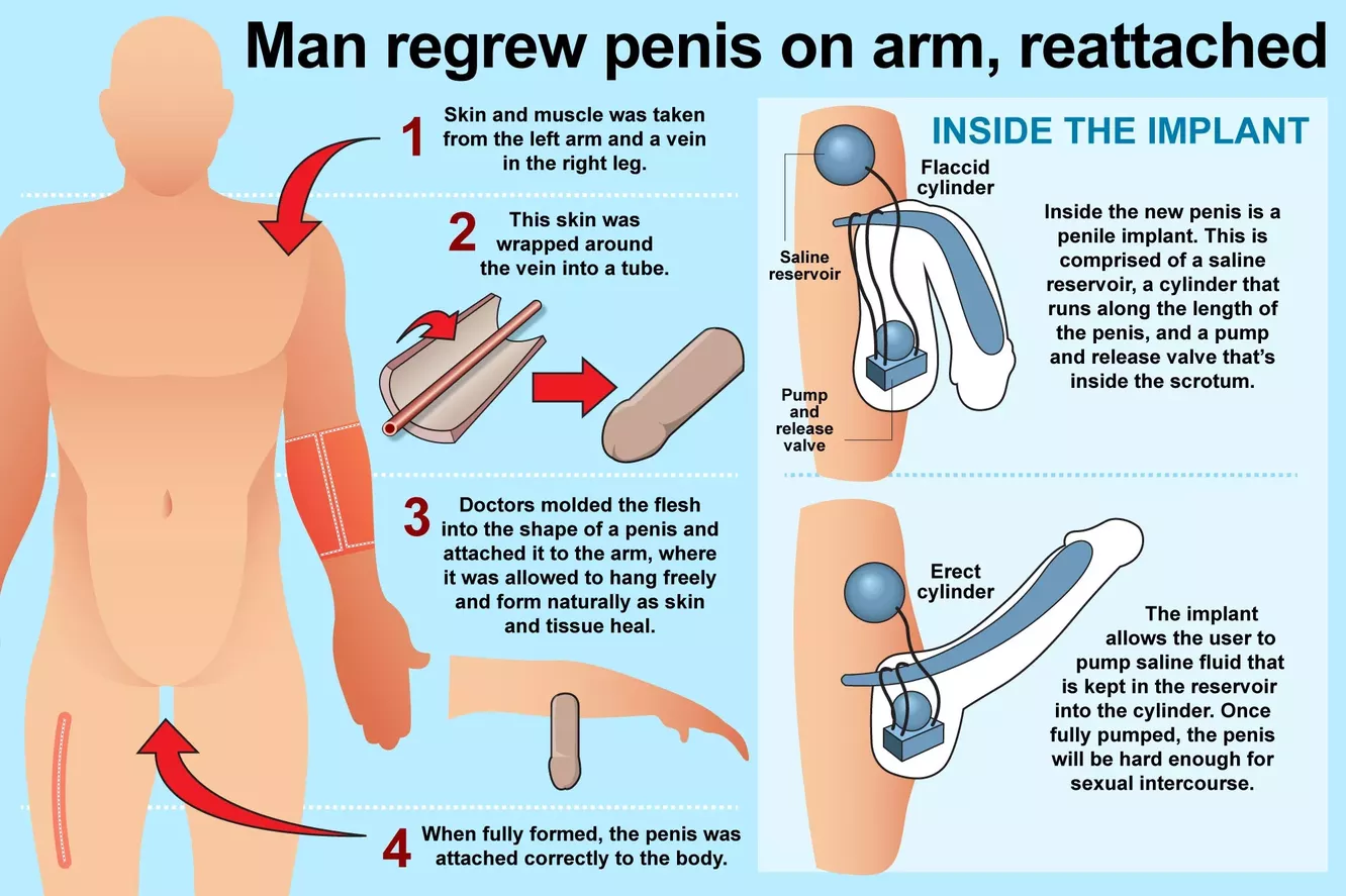 implanturi pentru penis ce să nu faci cu penisurile
