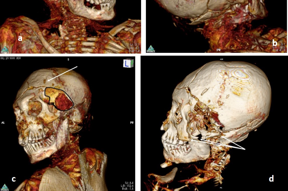Виртуальное вскрытие показало, что две южноамериканские мумии были жестоко убиты
